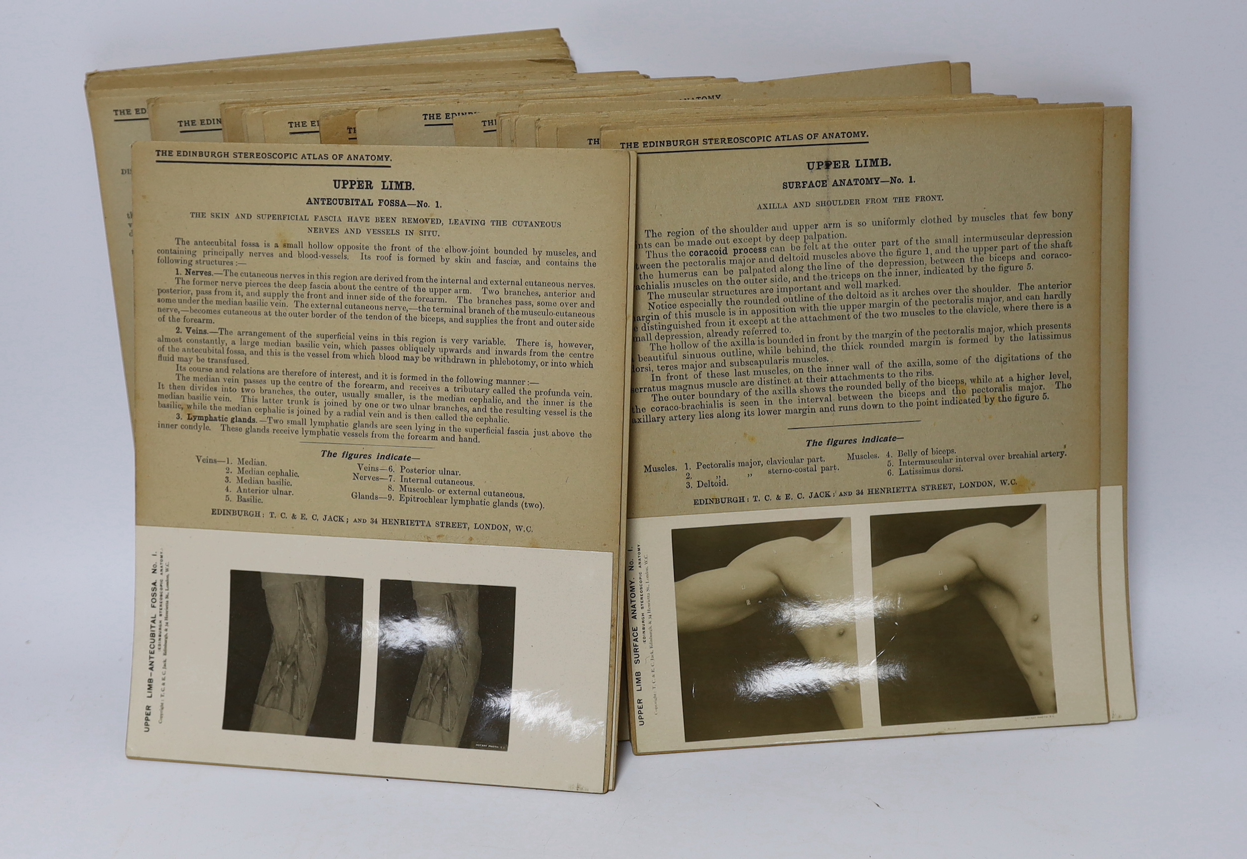 Stereoscopic cards from a set by The Edinburgh Stereoscopic Atlas of Anatomy with detailed information above the photographs, together with a small number of additional cards of different subjects